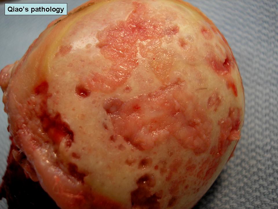 Gross morphology of osteoarthritis in hip