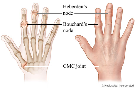 Diagram of Heberden nodes and Bouchard nodes