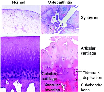 Gross morphology of osteoarthritis in hip